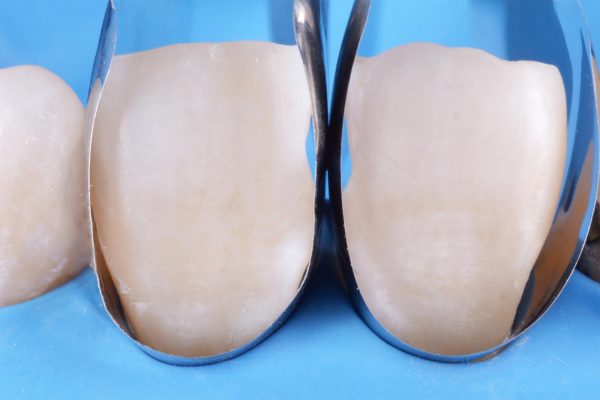 Unica Anterior Matrices